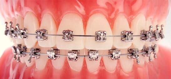 Dental Clinic in Brighton Adelaide|Quality Dental Care in Brighton South Australia dental clinic in brighton Dental Clinic in Brighton Adelaide|Quality Dental Care in Brighton South Australia ORTHODONTIC TREATMENT 2