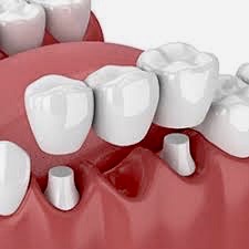 Dental implant clinic in Brighton | Quality Dental Care | Adelaide, South Australia dental implant clinic in brighton Dental implant clinic in Brighton | Quality Dental Care | Adelaide, South Australia QDC 390 2