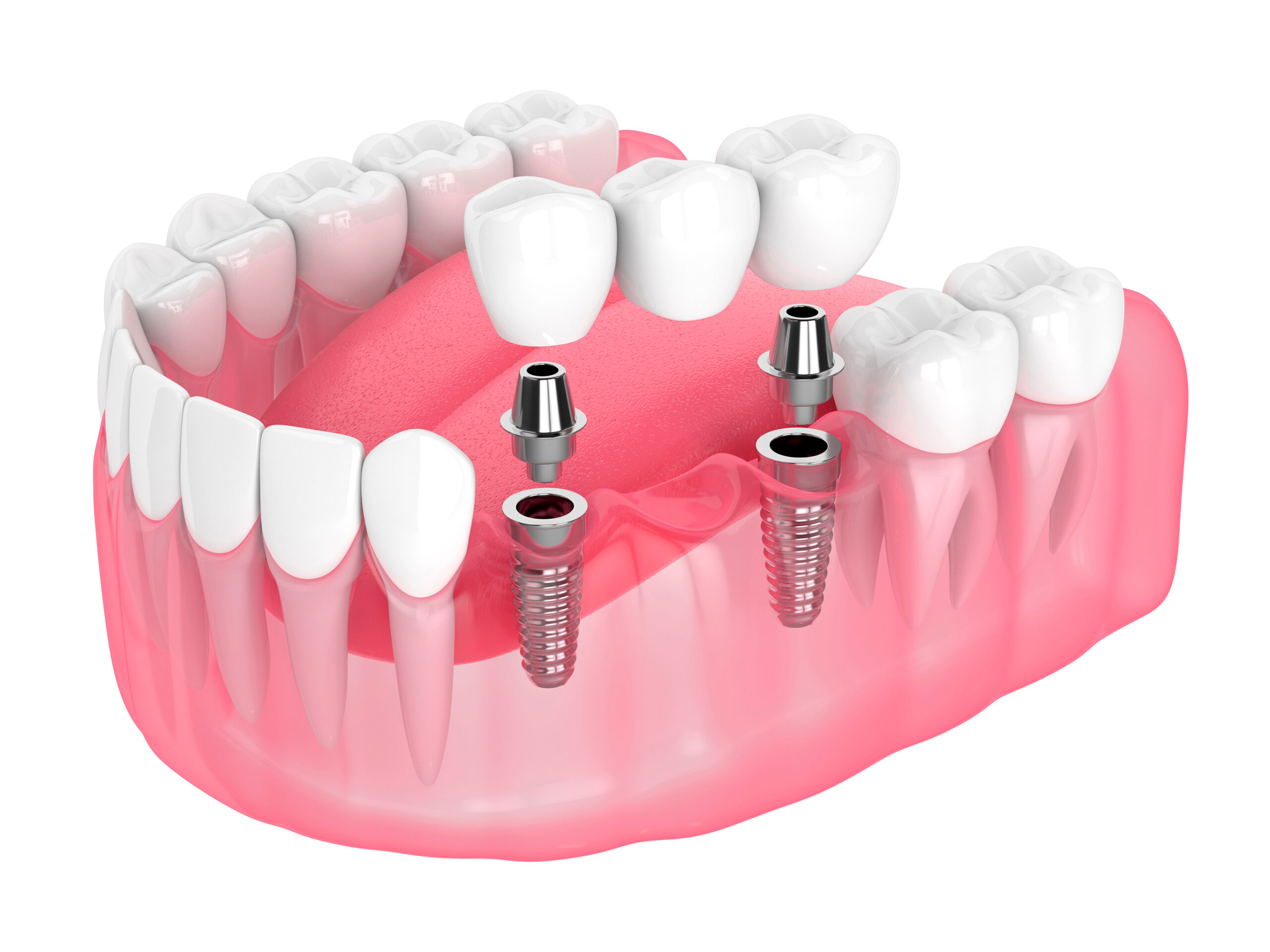 Dentistry Crowns and Bridges | Quality Dental Care | Adelaide, South Australia dentistry crowns and bridges Dentistry Crowns and Bridges | Quality Dental Care | Adelaide, South Australia 38386533b7c34f6b9dabc2258b2af172 scaled