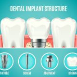Types of Dental Implants | Quality Dental Care | Adelaide, South Australia   type of dental implants 1 160x160