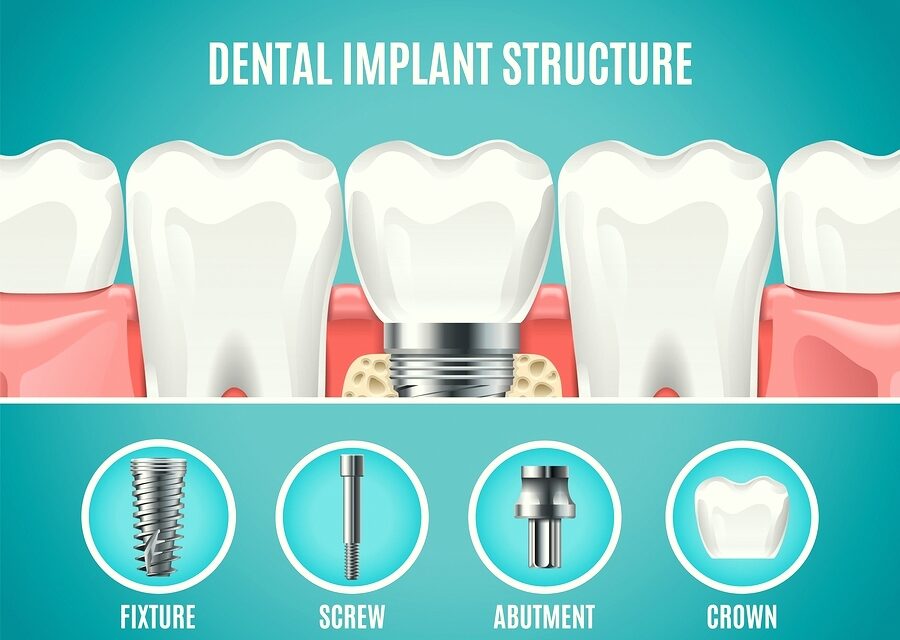 https://qualitydentalcare.com.au/wp-content/uploads/2022/03/type-of-dental-implants-1-900x640.jpg